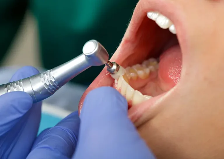 An image of a cleaning at Foothills Dental